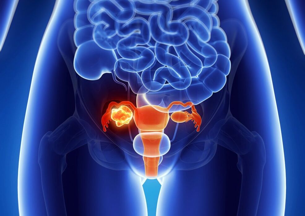 Frauen Eierstockpathologie unter Alkoholeinfluss